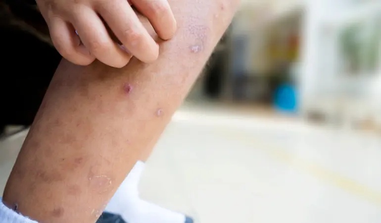 طريقة القضاء على البق نهائيا بـ 3 خطوات مجربة تعرف عليها الآن